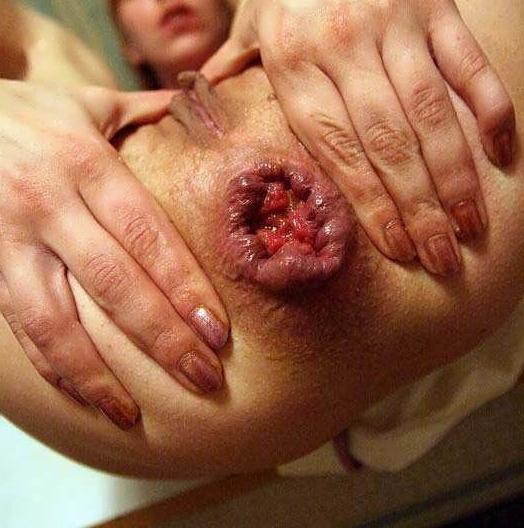 ANAL (42)
