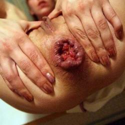 ANAL